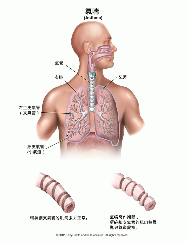 氣喘 插圖