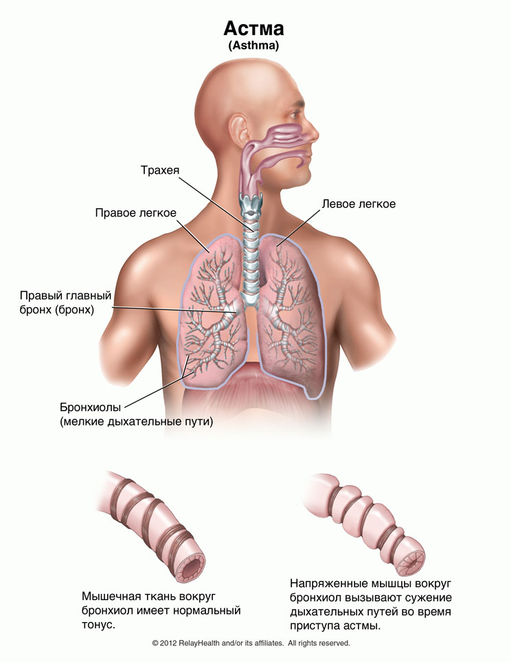 Астма: иллюстрация
