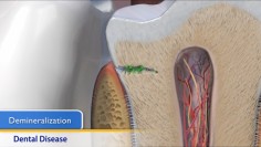 Thumbnail image of: Dental Disease (Animation)